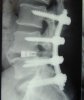 Arthrodeses-lombaire-et-dorso-lombaire-2.jpg